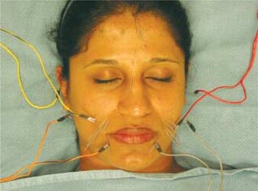 Electroacupuncture treatment.