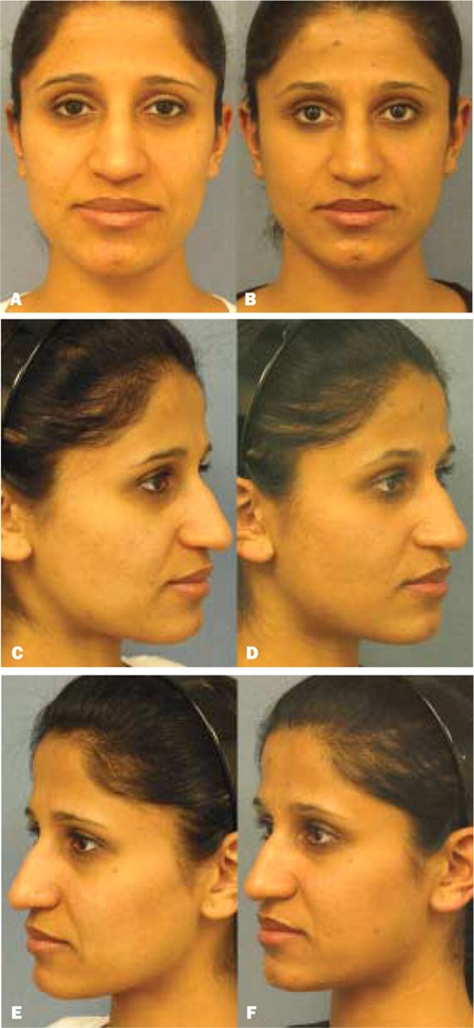 A, C, E, Pretreatment views of a 26-year-old woman requesting reduction in the prominence of her nasolabial folds. B, D, F, Posttreatment views 30 minutes after the last of 10 acupuncture treatments (as described in Table).