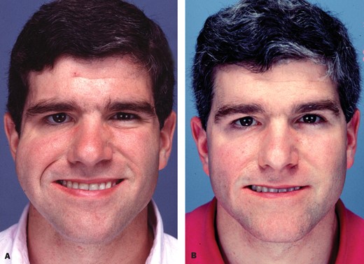 A, This 24-year-old man has right developmental facial paralysis. After undergoing 3 cross facial nerve grafts in 1988 and free gracilis muscle transplantation in 1990, he was unhappy about the deep crease in his right nasolabial fold and a bulky right cheek. B, The patient is shown 7 years after aggressive debulking of the right cheek and placement of a dermal fat graft through an intraoral incision. A mini tendon graft was used to suspend the right lower eyelid.