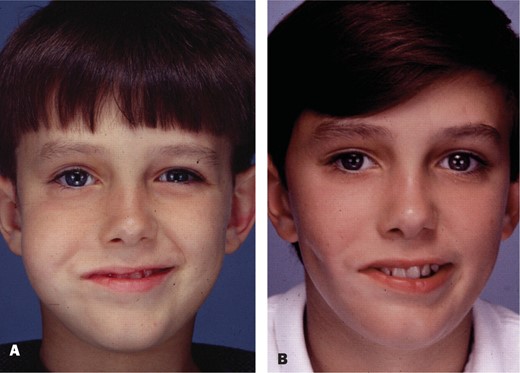 A, This 7-year-old boy has right developmental facial paralysis. He underwent 4 cross facial nerve grafts and a left pectoralis minor muscle transfer to the right cheek. His parents are now concerned with his bulky right cheek. B, The patient is shown several years after aggressive debulking of the right cheek through a preauricular incision.