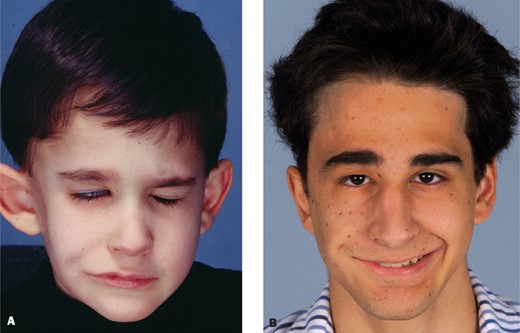A, This 3-year-old boy was born with right developmental facial paralysis. He had 3 cross facial nerve grafts and a microneurovascular transfer of the left pectoralis minor to the right cheek. His parents would like to correct the loss of soft tissue and asymmetric bulk and concavity in the right cheek. B, The concavity in the right cheek was treated by a free vascularized posterior calf fascia. The patient also had bilateral otoplasty. He is seen here, in adolescence, nearly 13 years later.