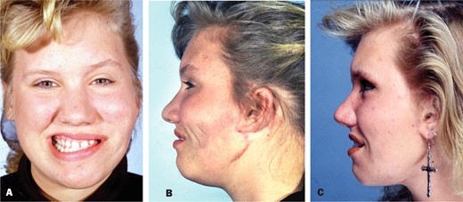 A, B, This young woman suffered left partial facial paralysis secondary to resection of a left parotid hemangioma when she was 3 months old. B, At age 11, she had 3 cross-facial nerve grafts. She then had a free right pectoralis minor transfer to the left cheek. She is currently unhappy with her bulky left cheek and the creases in her left cheek when she animates. C, The patient is seen with the creases effectively corrected by the interposition of a left superficial temporal fascial flap. The left lower lip paralysis was treated by a pedicle left digastric transfer.