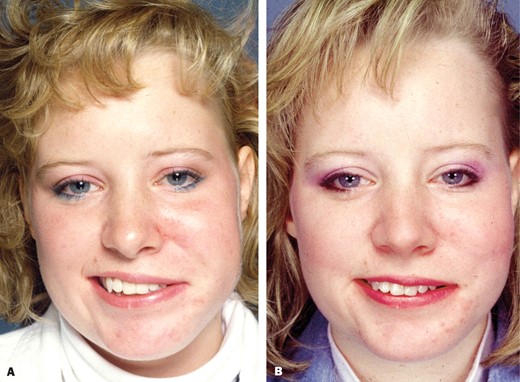 A, This 17-year-old girl, born in 1969, had progressive hearing loss that led to 2 surgeries in 1976 and 1977 (including left tympanotomy, left mastoidectomy and left stapedectomy) for conductive hearing loss. Following a repeat stapedectomy procedure in 1977, she developed a complete left hearing loss and a complete left facial paralysis. A month later, she had end-to-side coaptation of the left facial nerve. She presented in 1986, at age 17, with left partial facial palsy and synkinesis between the eye and oral sphincters. In 1986, she had 2 cross-facial nerve grafts. In 1987, she had a right pectoralis minor transfer to the left face. She now would like treatment for her bulky left cheek and inadequate elevation of the left upper lip. B, The patient was treated with a left mini temporalis transfer to the left upper lip, and lipoplasty and fat excision in the left cheek to correct the bulk.