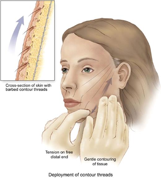 Contouring procedure. Tension is held on the end of the suture exiting the skin. The skin is manipulated to engage the barbs on the sutures. The weight of the tissues is then maintained and distributed among the barbs, each one holding a small amount of weight.