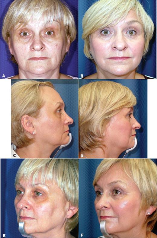 A, C, E, Preoperative views of a 54-year-old patient. B, D, F, Postoperative view 4 months after Contour Thread treatment to the cheek and jowls (4 threads per side, 8 threads in total).
