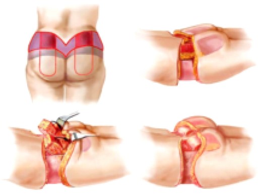 Creation of an autologous buttock augmentation flap. Tissue to be excised is in purple, and the deepithelialized flaps are in red. The flap is dissected down to the fascia perpendicularly in the superior, medial, and lateral edge, and at an oblique angle, inferiorly undermining it. Fascia is undermined superiorly until the flap can be rotated caudally 180 degrees into the pocket and anchored to the fascia with suture. The remaining buttock skin is pulled to cover the flap.