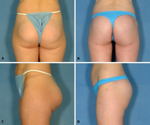 A, C, Preoperative views of a 32-year-old woman with prior buttock augmentation with round 270-cc silicone gel–filled implants that resulted in ptosis and double bubble appearance. B, D, Postoperative views 6 months after removal of implants and performance of a buttock lift with autoprosthesis augmentation.