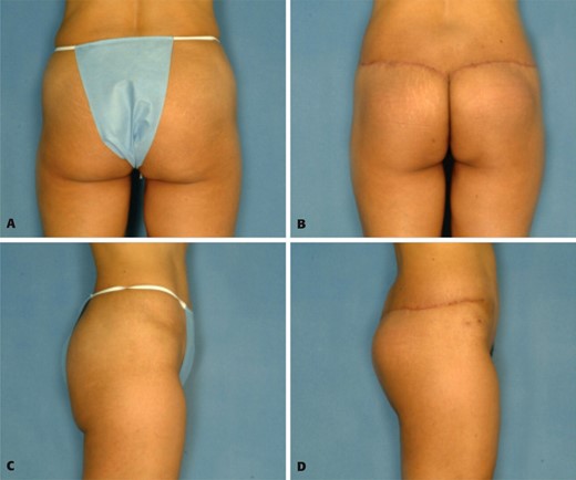 A, C, Preoperative view of a thin 45-year-old woman who was unhappy with the sagging and lack of projection of her buttocks. Postoperative views 6 months after autoprosthesis buttock lift and augmentation demonstrate shortening of elongated buttock and increased projection. The infragluteal crease is considerably shorter, and there is additional improvement of the waistline.