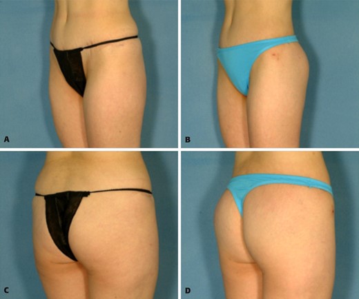 A, C, Preoperative views of a 42-year-old patient who desired correction of buttock contour and augmentation. B, D, Postoperative views 6 months after augmentation.