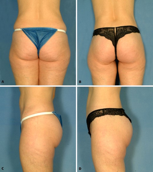 A, C, Preoperative views of a 40-year-old woman who desired improvement of the buttocks and waist and lateral thigh contour. B, D, Postoperative views 6 months after buttocks lift with autoprosthesis augmentation and lateral thigh lift.