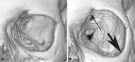 Computed tomography scan of a male patient in the young age group (A) and a male patient in the old age group (B). The image from the old age groups shows significant bony remodeling (arrows) both superomedially and inferolaterally.