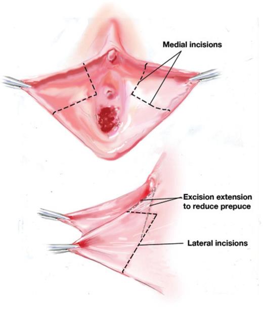 Stodolski recommends best of How was deep throat information confirmed the surgical clitoris Unhooding enlarged