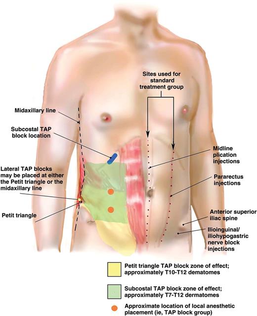 Tap Injection Illustration of common sites of nerve blocks for the abdominal wall ...