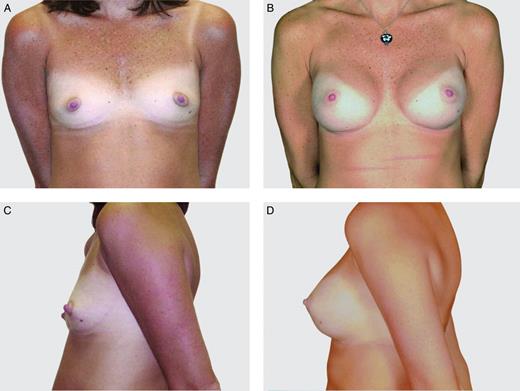 This 33-year-old woman is shown before (A, C) and 10 years (B, D) after breast augmentation with 255-cc Natrelle 410 moderate height, full projection implants.