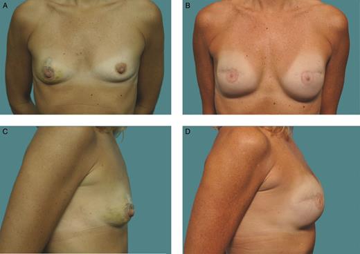 This 36-year-old woman is shown before (A, C) and 10 years after (B, D) breast reconstruction with a bilateral neopectoral pocket conversion and placement of 255-cc Natrelle 410 full height, full projection implants.