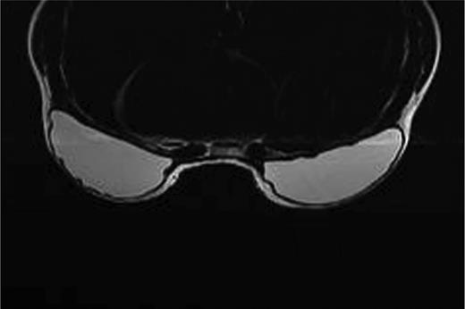 Magnetic resonance imaging scan taken 10 years after breast reconstruction with a bilateral neopectoral pocket conversion and placement of 255-cc Natrelle 410 full height, full projection implants in the 36-year-old woman shown in Figure 5.