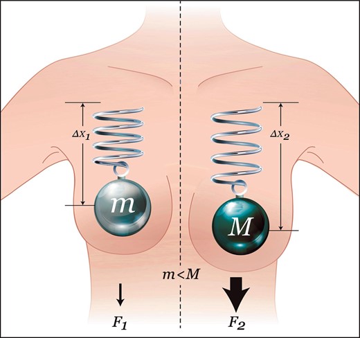 Hooke's law and breast tissue responses. The elastic tissue of the breast is symbolized by a spring with constant K. In a static, upright posture, the weight of an implant will displace the breast downwards with a force proportional to the weight of the implant, as described by the following formula: , where F is the force, m is the mass, and g is the standard gravity constant. The tissue's stretch is linear (within the elasticity limits of the tissue), and, therefore, tissue displacement will increase in direct correlation with implant weight. The displacement is described as , where is the displacement, F is the force applied, and K is the spring constant. A heavier implant will result in increased forces and consequential stretch of the breast, as compared with a lighter implant. Therefore, as can be seen in Figure 1, F1 < F2 and . Reprinted with permission from G&G Biotechnology Ltd., Haifa, Israel.