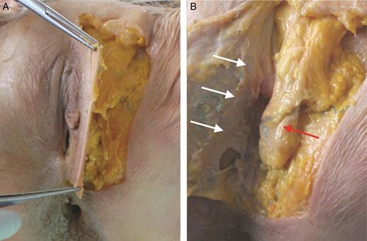 Dissection of labia majora (LM) in a 61-year-old female cadaver. (A) Incision is performed on the lateral margin of LM and the skin is gently retracted medially. (B) On the posterior side of this flap, the lip dartos could be observed (white arrows). This layer is composed of smooth muscle and is more represented on the lateral and inferior sides of the LM. The fibrous tunic (or elastic sack) contains the fat body of LM (red arrow) and fan fibers of round ligament. The caudal third of the sack is close to the fork. These images were acquired during a conventional cadaver dissection for educational purposes. Institutional review board (IRB) approval was not required.