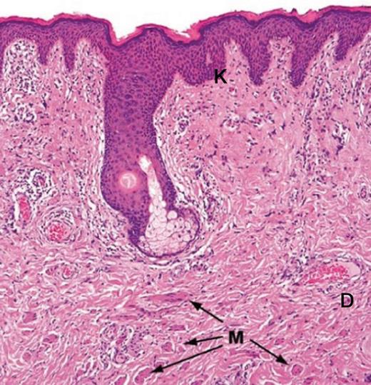 This section (hematoxylin and eosin staining) illustrates the keratinized and stratified squamous epithelium (K) of the labia majora. This epithelium includes hair follicles, sebaceous and apocrine glands. The dartos layer (D) is rich of connective tissue and smooth muscle (M).