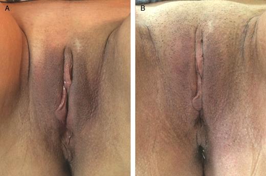 A 56-year-old woman affected by mild hypotrophy of labia majora. The patient received 19 mg/mL hyaluronic acid, 0.7 mL on the right labium and 1.3 mL on the left labium. (A) A preoperative photograph and the result at 12 months (B) from the first treatment are shown.