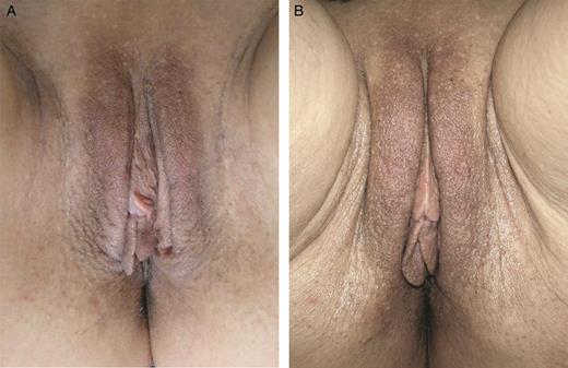 A 63-year-old woman affected by moderate hypotrophy of labia majora. The patient received 19 mg/mL hyaluronic acid, 1 mL per part. At 6 months later a second treatment with 19 mg/mL hyaluronic acid was carried out (1 mL per part). (A) A preoperative photograph and the result at 12 months (B) from the first treatment are shown.