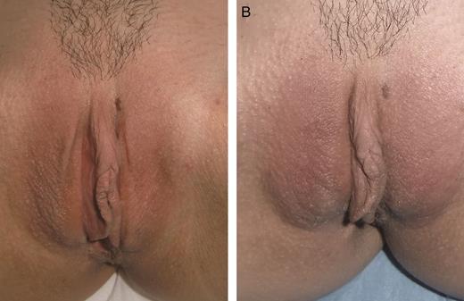 A 34-year-old woman affected by severe hypotrophy of labia majora. The patient was infiltrated with 21 mg/mL hyaluronic acid, 1 mL per part. At 7 weeks later, a second infiltration with 19 mg/mL hyaluronic acid was carried out (1 mL per part). (A) A preoperative photograph and the result at 12 months (B) from the first infiltration are shown.