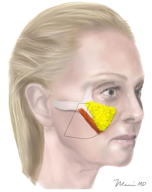 Deep-plane transition zone (DTZ). The borders of the trapezoidal-shaped DTZ are: laterally, an oblique line starting 4.5 cm anterior to the tragus and ending 2.5 cm antero-inferior to the ear lobule, even with the oral commissure; superiorly, the midpoint of the zygomatic arch; medially, the zygomaticus major muscle with an anterior bend over the prezygomatic space; and inferiorly, the transverse line even with the oral commissure. As shown in Figure 5 , the deep-plane dissection continues inferior to this line, across the jawline and into the neck, but the area above it is the portion relevant to midface elevation.