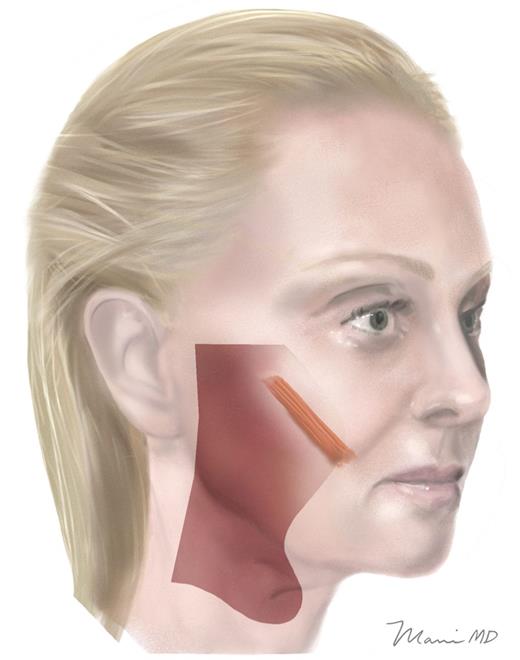 SMAS layer attenuation. The thinning of the SMAS as it courses towards the zygomaticus major muscle is shown.