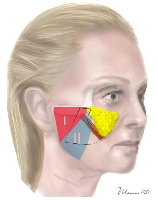SMAS strength zones with DTZ overlaid. The DTZ overlaps the weaker medial SMAS in the midface. This ensures that the flap in this area is structurally and functionally adequate to transmit tension into the midface.