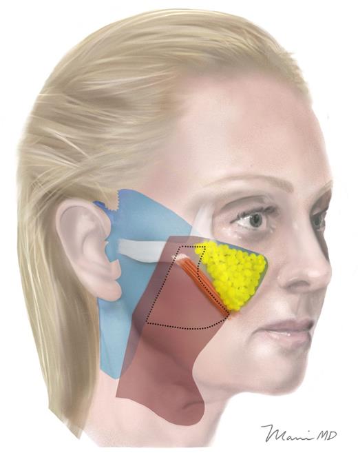 Areas of undermining for the author's technique. Limits of skin (in blue) and SMAS (in red) undermining for the author's technique, with the DTZ entirely within the red area of composite-flap undermining. The area of undermining medial to the zygomaticus major muscle is subcutaneous by definition, since there is no SMAS layer in this zone. (The premasseteric dissection joins an extended subplatysmal dissection into the neck. Platysma, but not skin, is undermined towards the midline of the neck, preserving cervical facial nerve branches. This continuation of the facial composite flap into the neck generates a very smooth, youthful jaw and neckline, while elevating ptotic submandibular glands and avoiding irregularities characteristic of subcutaneous neck dissection.)