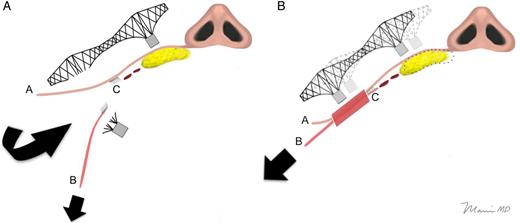 (A) This diagram of an axial section at the level of the nasal base illustrates what happens in a dissection where the skin and SMAS are separated in the DTZ. This dissection transects the first support of the “cantilever bridge” that transmits lateral SMAS tension into the malar fat pad. The image shows the skin (“A”) being separated from the SMAS (“B”), and this separation extends (as it does in the traditional bilamellar SMAS lifting techniques) medially, to beyond the location of the zygomaticus muscles. Traction applied to the SMAS separates it farther from the malar fat pad because all durable attachments, including retaining ligaments (“C”), between it and the SMAS have been severed by the subcutaneous dissection. Although the main vector of pull tends to be more vertical, the lateral vector is shown for purposes of this illustration. (B) In contrast, the second diagram of an axial section where the skin (“A”) and SMAS (“B”) have been left attached to one another in the DTZ (red-shaded area) illustrates the “cantilever bridge effect” of the skin elevating the malar fat pad up as the SMAS is elevated. Traction on the SMAS transmits via the skin to the malar fat pad, which shifts superolaterally (its former location being shown by the dotted outline). Retaining ligaments (“C”) are left intact at the subcutaneous level. Although not specifically shown in this diagram, retaining ligaments are separated at the sub-SMAS level in both composite flap and bilamellar techniques.