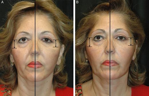 Half-and-half photograph showing a mirror image of the right (A) and left (B) hemiface of a 54-year-old woman before and 12 months after total composite flap facelift, and reference marks used for measurements. The midpupil to lid/cheek junction was measured. This measuring technique is similar to that recommended by Hamra as the most objective means available of assessing midface elevation.