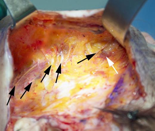 Total composite flap facelift dissection as demonstrated on a 52-year-old woman. Upper and lower key masseteric ligaments, as well as zygomatic ligaments, have been fully released. At upper right are the prezygomatic space and the origin of the zygomaticus major muscle (white arrow). Orbicularis oculi fibers have been elevated with the composite flap, and are visible being retracted above zygomaticus major. Facial nerve branches are visible and are marked by black arrows. Left to right, these branches are: marginal mandibular branch, lower buccal trunk, upper buccal trunk, zygomatic branch, and zygomatic branch to orbicularis oculi (coursing over the zygomaticus major muscle).