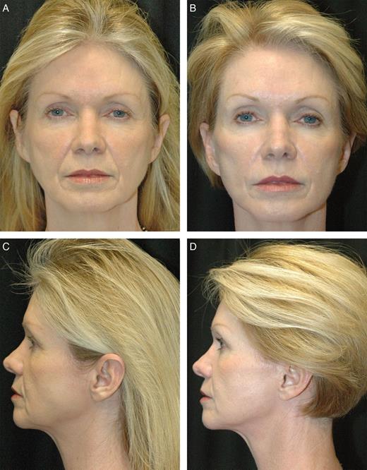 Example of a bilamellar facelift (early group). This 56-year-old woman complained of general facial aging and said that people thought she looked angry even when she was not. On examination she had moderate midfacial deep tissue ptosis, deepening nasolabial folds, and jowling, as well as platysmal laxity. (A, C) Preoperative and (B, D) 24 month postoperative photographs of a facelift with skin and SMAS raised as separate flaps in the DTZ and midline corset platysmaplasty. She also underwent endoscopic browlift and upper blepharoplasty. The elevation of midfacial highlights in this case was negligible.