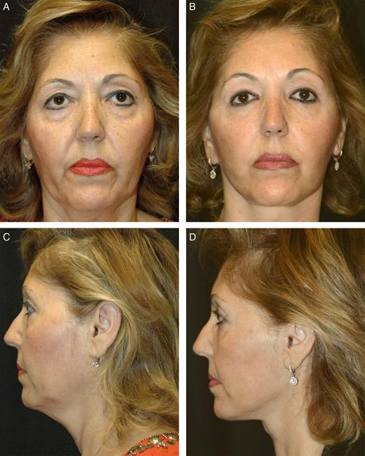 Example of a total composite flap facelift (later group). This 54-year-old woman (same patient featured in Figure 7 ) complained of looking tired and droopy. Examination showed severe ptosis of mid- and lower deep facial tissues, platysmal laxity, and upper and lower lid blepharochalasis. (A, C) Preoperative and (B, D) 14 month postoperative photographs of a facelift with skin and SMAS left attached in the DTZ. She also underwent midline corset platysmaplasty with digastric shaving and partial inferior platysmal transection, upper blepharoplasty, and transconjunctival lower blepharoplasty with fat repositioning. Elevation of midfacial highlights was significant in this case (16% on right and 10% on left). The incision is not visible and the jawline is restored, without excessive thinning of the tissues which can occur with lateral neck skin undermining.