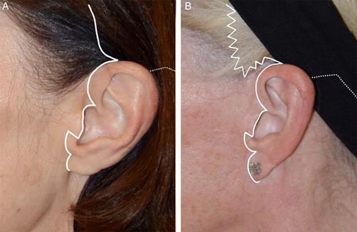 (A) Incision diagram for primary total composite flap facelift demonstrated on a 57-year-old woman. The incision begins in the temporal hair and angles posteriorly just above the helical root. It then curves downward and makes a sharp posterior angle just above the tragus, then continues just behind the crest of the tragus, turning acutely supero-anterior at the base of the tragus and then following the contour of the intertragal incisure to the upper ear lobe, with a notch just superior to the lobe and then around it. (The postauricular incision runs up the postauricular sulcus and just within the posterior hairline, acutely beveled so that hair grows through the hairless edge of the flap as it heals.) (B) Preauricular incision design for secondary total composite facelift demonstrated on a 60-year-old woman. To avoid raising the sideburn, the incision begins behind the anterior 1/3 of the sideburn with w-plasties which course under the sideburn as depicted. The remainder of the incision is the same as in Figure 11 A.