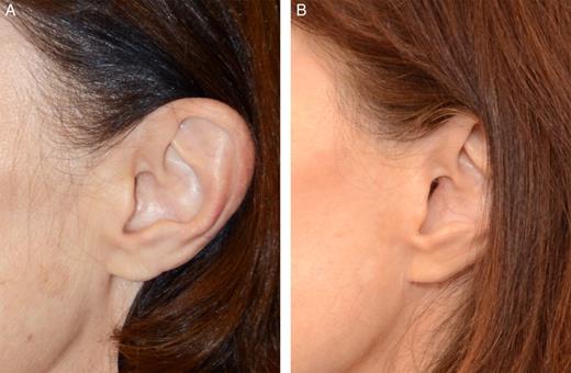 (A) Preoperative photograph of this 57-year-old woman's ear (same patient in Figure 11 A). (B) Fifteen-month postoperative photograph after primary total composite flap facelift, showing preservation of the tragal contours and the intertragal incisure below the tragus. The incision is essentially invisible even on close inspection.