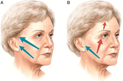(A) The direction of all lateral vector facelifts. (B) The direction of contralateral composite facelifts.