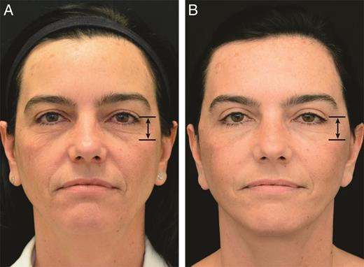 Preoperative (A) and 12 month postoperative (B) photographs of a 45-year-old woman from the author's Supplementary Figure 4. The height of the lower eyelid and the eyelid cheek junction are unchanged. From Mani. 1