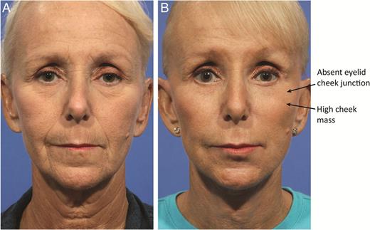 Preoperative (A) and 12 month postoperative (B) photographs of a 66-year-old woman after composite facelift. Note the high cheek mass and the absent eyelid cheek junction.