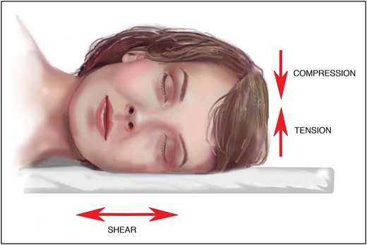 External forces (including compression, tension, and shear) act on facial tissue in lateral or prone sleep positions.