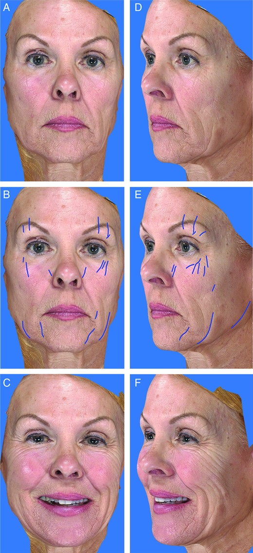 Sleep wrinkles can be distinguished from wrinkles of facial expression. (A, D) A 65-year-old women in repose, (B, E) with sleep wrinkles highlighted, and (C, F) in animation. Images taken with the Vectra 3D Image System (Canfield Scientific, Fairfield, NJ).