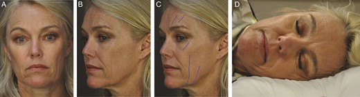 (A) Frontal and (B) oblique views on a 58-year-old woman, (C) with sleep wrinkles highlighted, (D) and lateral sleep simulation demonstrating sleep wrinkle etiology.