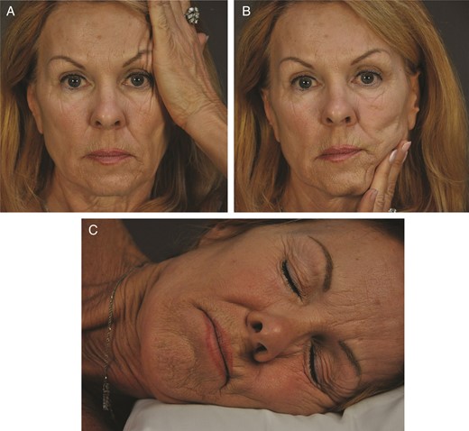 (A, B) Recreation of distortion with hand compression and (C) simulation of lateral sleep posture demonstrates causal forces in this 65-year-old woman.