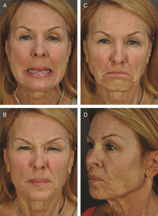 (A-D) Expression does not significantly reproduce sleep wrinkles in this 65-year-old woman.