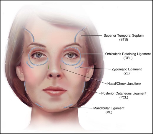 Retaining ligaments of the face are consistent with the location of most sleep wrinkles.