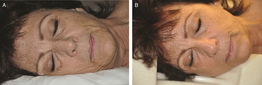 A 59-year-old woman demonstrating sleep wrinkles reinforced in (A) lateral sleep position and (B) compression reduced with a specialty JuveRest pillow (Las Vegas, NV).