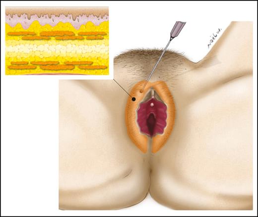 Fat injection for labia majora augmentation. The injection of fat should be done in multiple layers.