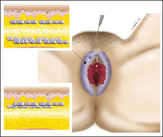 Hyaluronic acid injection for labia majora augmentation. Hyaluronic acid can be injected subcutaneously only or can be associated with deep injections under the Dartos fascia.