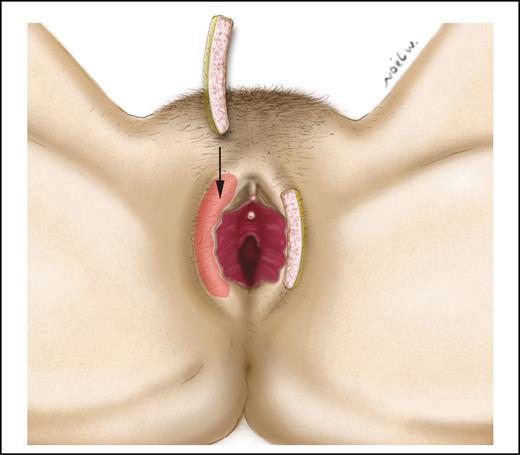 The 10 × 2 cm dermal fat grafts can be created from the de-epithelialized skin and inserted into pockets dissected into the labia majora.